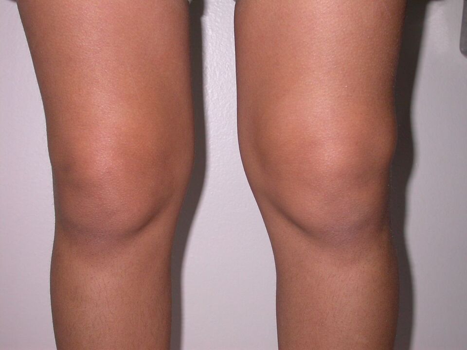 swelling of the knee due to osteoarthritis