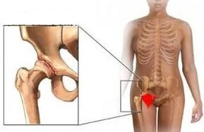 Reasons for developing hip union arthrosis