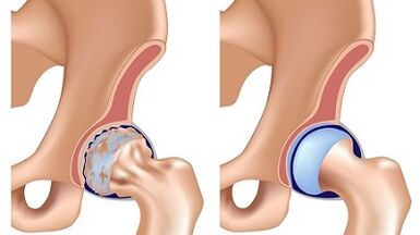 Symptoms of hip joint arthrosis