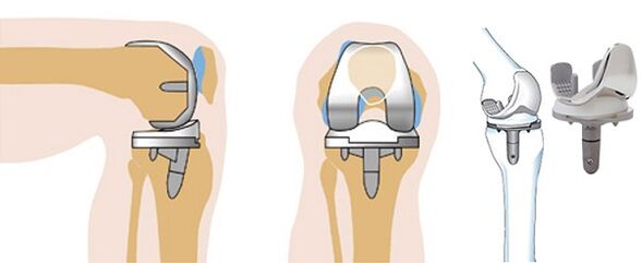 Endoprosthetic knee joint surgery for arthrosis