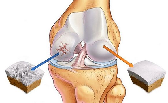 Rate and deviation for knee joint arthrosis