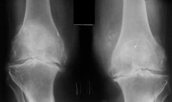 X -Ray as a way to diagnose knee joint arthrosis