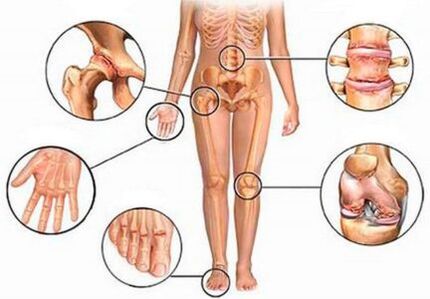 Arthritis and arthritis of different joints
