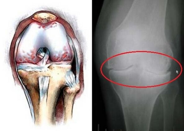 Deformation of the knee joint for arthrosis