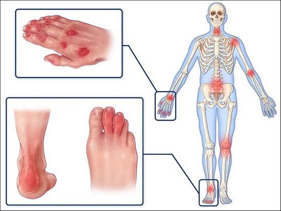 Rash and swelling of the arthritis joints