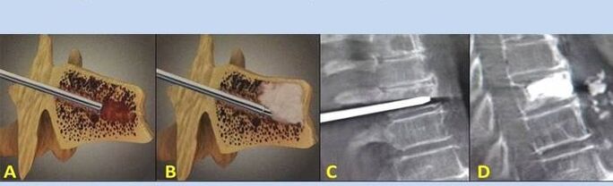 perforating vertebroplasty for back pain