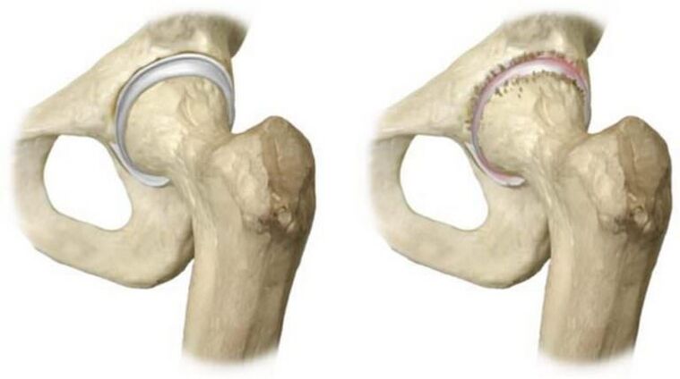 healthy hip joint and head necrosis as the cause of pain