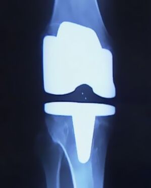 X-ray of the knee with an artificial prosthesis after joint replacement surgery