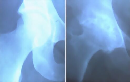 image of arthrosis of the knee joint