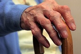 osteoarthritis of the fingers