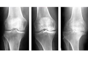 stages of joint osteoarthritis on an x-ray