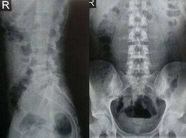 lumbar spine radiograph